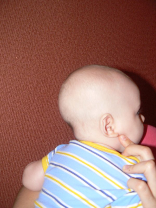 Затылок у ребенка в год. Краниостеноз скафоцефалия. Сагиттальный синостоз скафоцефалия.